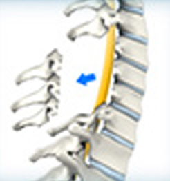 Cervical Laminectomy